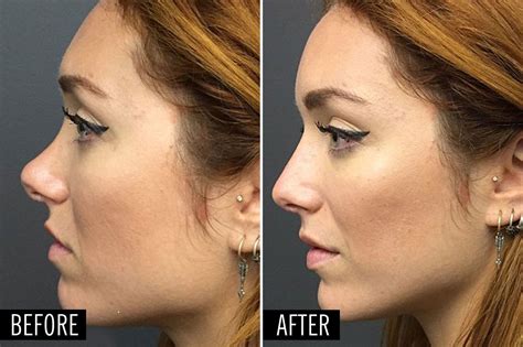 How A Plastic Surgeon Can Make This Nose Job Happen In 5 Minutes Face