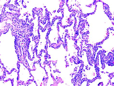 Non Specific Interstitial Pneumonia Nsip Cellular The Pure Cellular