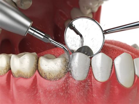 From making bread and plunging toilets to cutting hair and giving manicures. Possible Risks of Not Getting a Teeth Cleaning - North ...