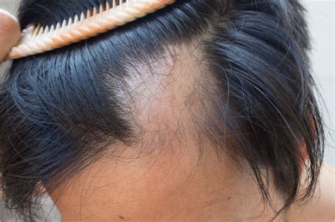 Abnormal Hair Loss Health Navigator Nz 2023