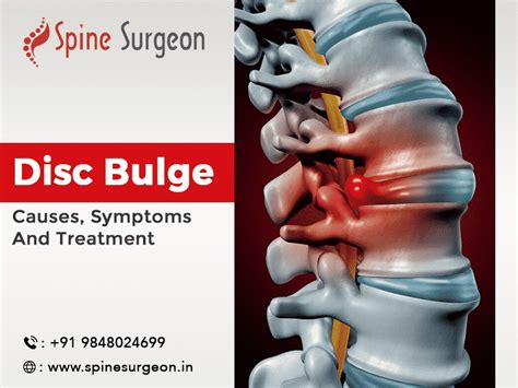 Disk Bulge Causes Symptoms And Treatment Spine Surgeon