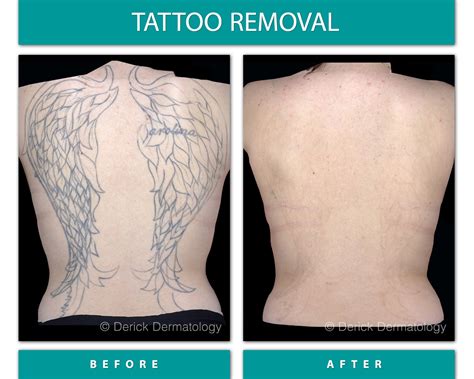Details 69 Before And After Tattoo Best Vn