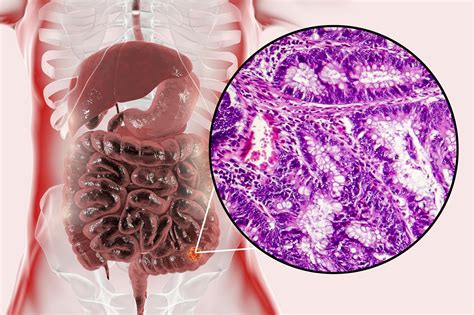 What's causing your stomach ache? Real-Time Computer-Aided System Improves Adenoma Detection Rate During Colonoscopy ...
