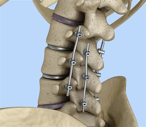 Spinal Fixation System Titanium Bracket 3d Model Cgtrader