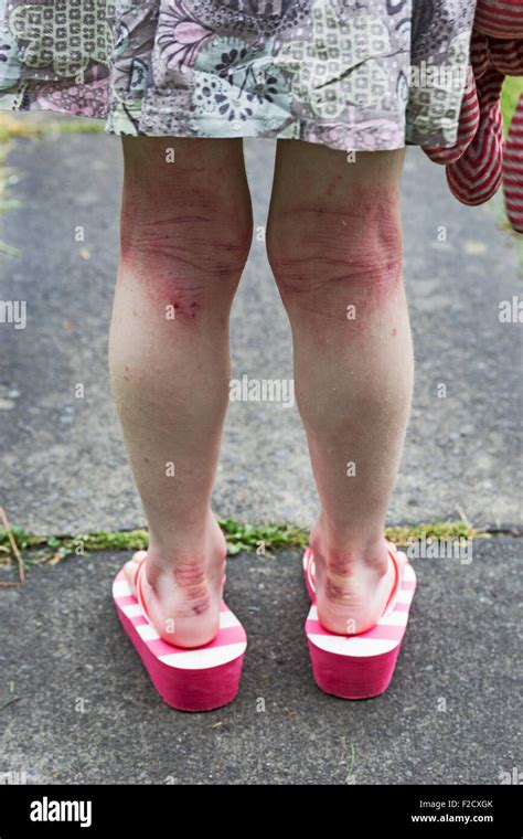 Atopic Dermatitis Stock Photos And Atopic Dermatitis Stock Images Alamy