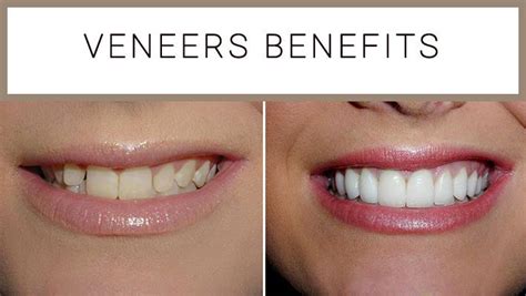 The Perfect Smile Incredible Benefits Of Veneers