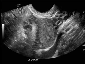 Pouch of douglas cystic lesion. Case report: a tale of two pregnancies - O&G Magazine