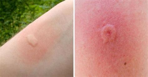 12 Common Bug Bites And How To Recognize Each One Fly Bites Insect