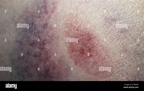 Big Bruise Hematoma After Hit On Human Body Skin Congestion Macro