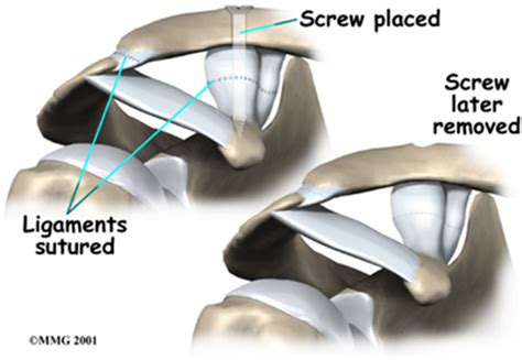 Ac Joint Separation Brisbane Knee And Shoulder Clinic Dr