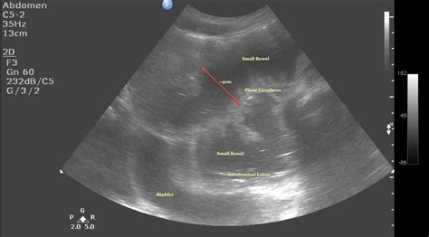 Small Bowel Obstruction Ultrasound Cases Info