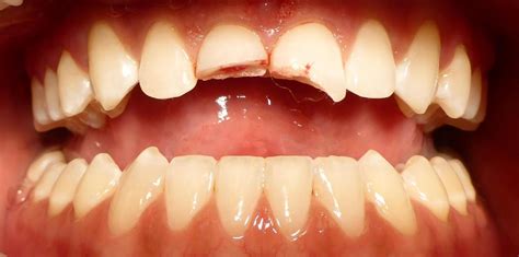 Before And After Cracked Tooth Repair Images Dentist Grapevine Tx