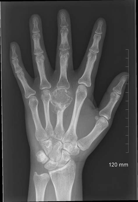 38yo With Severe Atraumatic Hand Pain Whats Your Differential