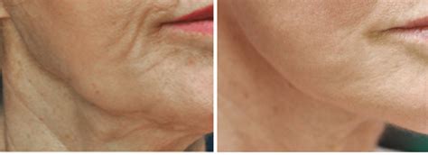Profound Before And After1 1 Columbia Skin Clinic
