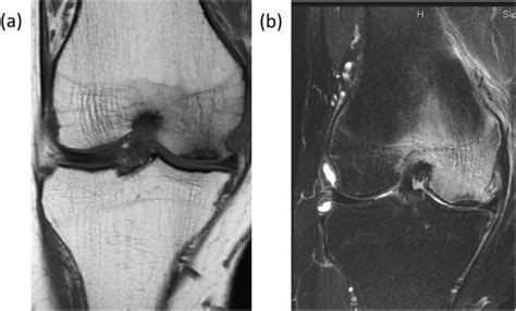Radiographic Deformities Of The Lower Extremity In Patients With