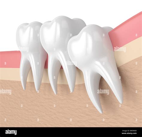 3d Render Of Teeth With Wisdom Crowding Concept Of Different Types Of