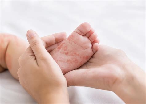 Dermatite De Contato Clínica Ideal Doenças Alérgicas