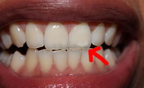 Wann brauchen sie eine zahnfüllung? Ursache für weißen Fleck im Zahn? (mit Bild) (Gesundheit ...