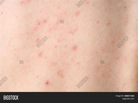 Skin Acne Red Spots Image And Photo Free Trial Bigstock