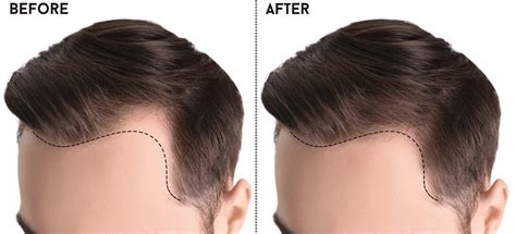 How Much Does A Full Hair Transplant Cost Home Design Ideas