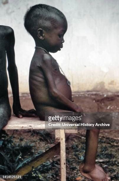 Kwashiorkor Photos And Premium High Res Pictures Getty Images