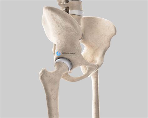 Revision Total Hip Replacement Orthoinfo Aaos 40f