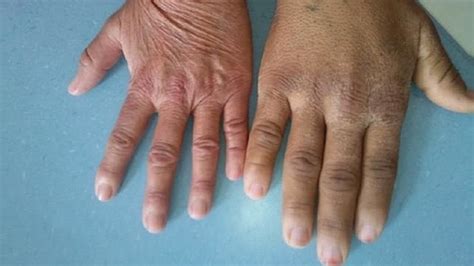 Understanding The Nuanced Management Of Acromegaly