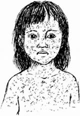 Measles Health Children Rubeola Problems Hesperian sketch template
