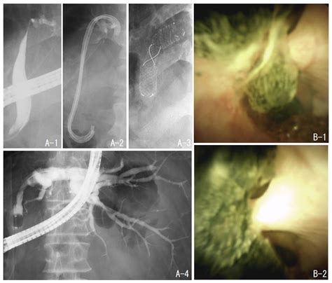 Jcm Free Full Text The Usefulness Of Peroral Cholangioscopy For