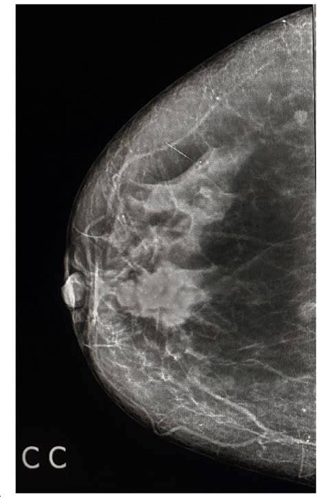 Imaging Features As Regards The Breast Cancer HER2 Neu Receptor Status
