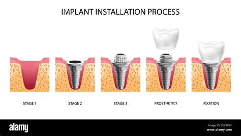 Cinco Etapas De La Instalación Del Implante Dental Ilustración Realista