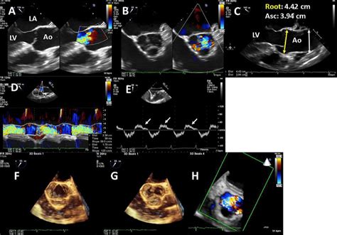 Optimal Use Of Echocardiography In Valvular Heart Disease Evaluation Heart