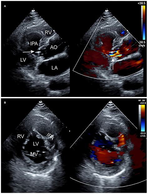 Frontiers Case Report A Giant Left Ventricular Intramural
