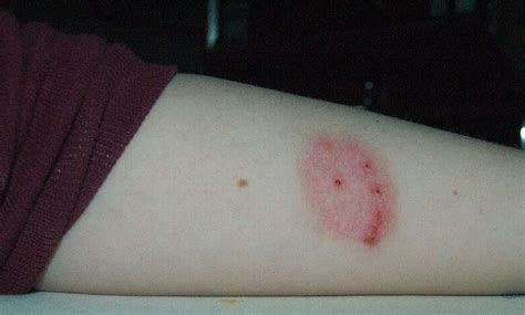 What Does A Spider Bite Look Like In The Beginning Spider Bites Black