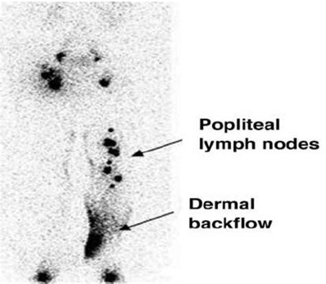 The Popliteal Lymph Nodes And Dermal Back Flow As Seen In A Patient