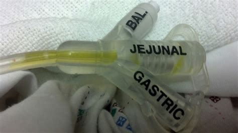 My New J Tube Feeding Tube Ostomy Crohns Disease