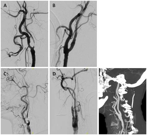 Frontiers Imaging Identification And Prognosis Of The Distal Internal