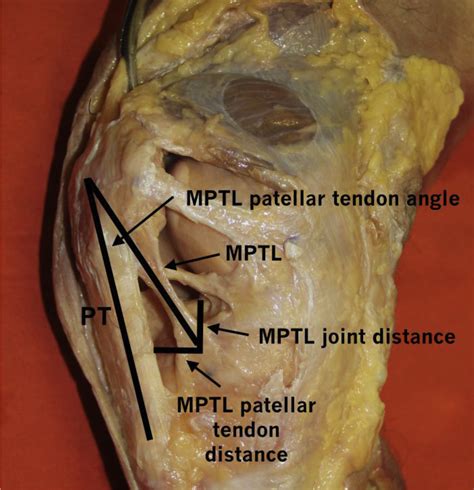 Medial Patellofemoral Ligament Medial Patellotibial Ligament And