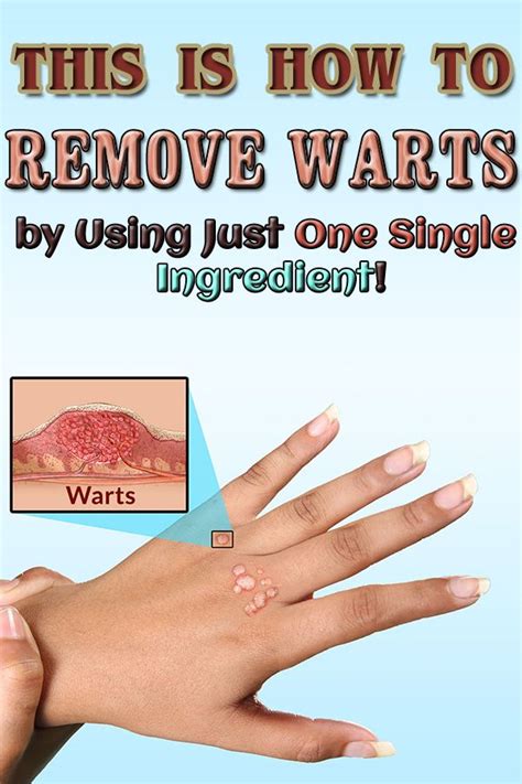 How To Remove Warts A Comprehensive Guide Ihsanpedia
