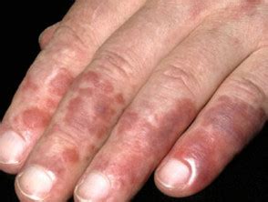 Check spelling or type a new query. Chilblain lupus erythematosus | DermNet NZ
