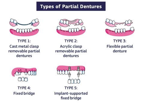 Partial Dentures Cost Treatment And Types In India