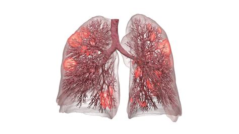 3d Lung Model Enables Safer Ventilation Axis Imaging News