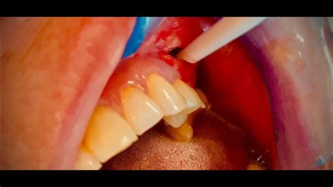 Incise And Drain Of A Severe Dental Abscess Pus Youtube