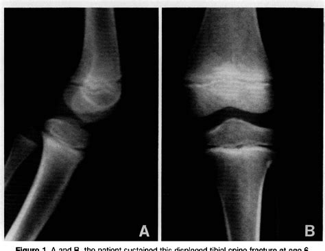 Figure 1 From Open Reduction Of A Malunited Tibial Spine Fracture In A