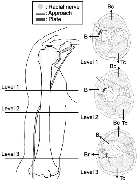 Anterolateral Approach Humerus