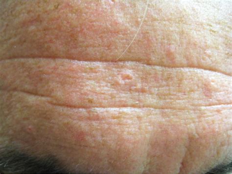 Benign Skin Lesions Definition Common Benign Skin Lesions Diagnosis The Best Porn Website