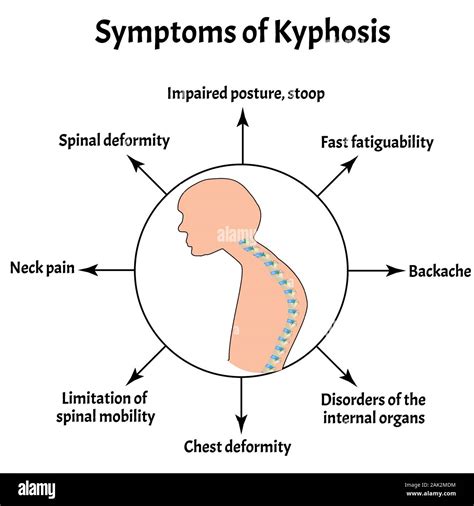 Symptoms Of Kyphosis Spinal Curvature Kyphosis Lordosis Scoliosis