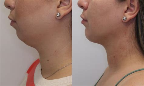 Jawline Contouring Before And After 11 Dr Rodriguez Feliz