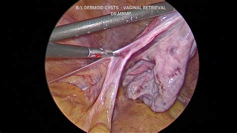 What Is A Dermoid Cyst Hot Sex Picture