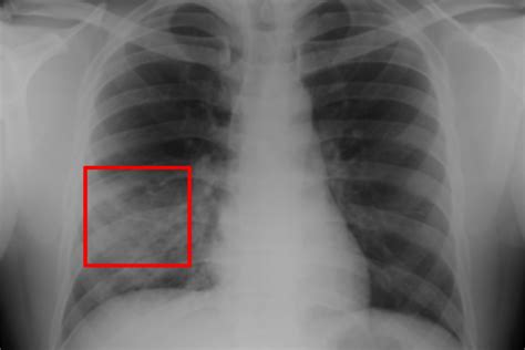 Ai Algorithm Differentiates Normal From Abnormal Chest X Rays Health
